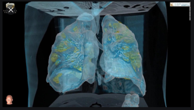 CT imaging of damage to the lungs from Covid-19 infection, made by George Washington University and reproduced by the New York Times in its video.