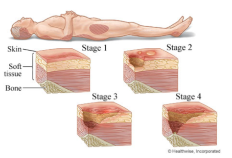 Staging of pressure sores, image by MyHealth.Alberta.ca