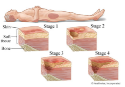Staging of pressure sores, image by MyHealth.Alberta.ca